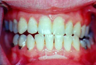 after periodontal treatment