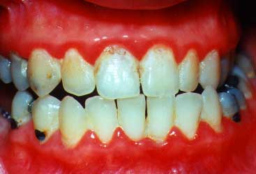 gum disease periodontitis